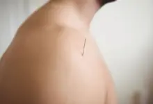 Acupuntura cura tendinite