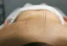Acupuntura tem comprovação científica