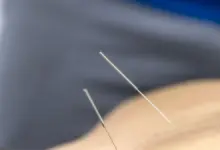 Acupuntura benefícios e malefícios
