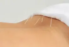Acupuntura para nervo ciático