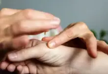 Acupuntura para síndrome do túnel do carpo