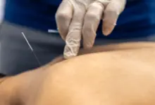Acupuntura para coluna é segura