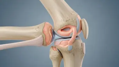 Cirurgia para artrose no joelho