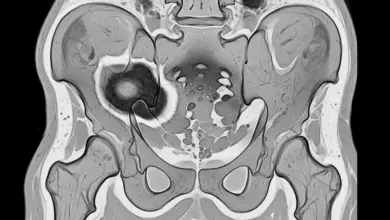 Necrose avascular do quadril
