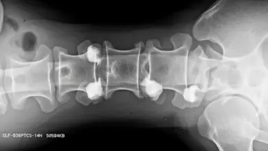Osteoartrite interapofisária