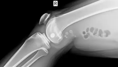 Osteoartrite primária