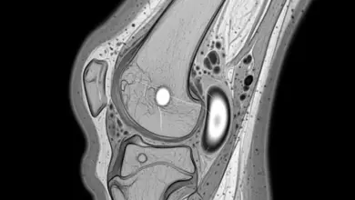 Cisto meniscal