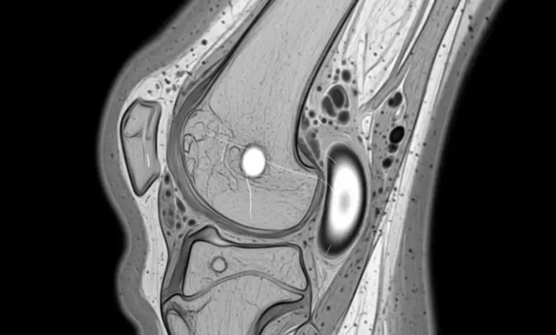 Cisto meniscal