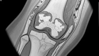 Condrossarcoma de baixo grau