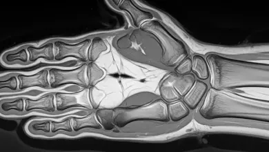 Lesão do ligamento escafolunar