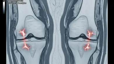 Osteonecrose dos côndilos femorais