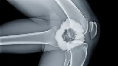 Osteossarcoma do joelho