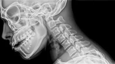 Cirurgia de deformidade cervical