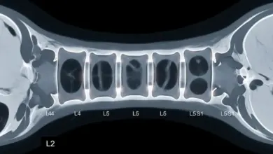 Desidratação discal tem cura