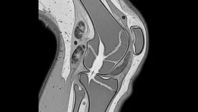 Lesão do ligamento colateral medial do joelho
