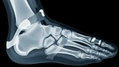 Fratura de Lisfranc