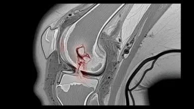 Lesão de LCM precisa de cirurgia