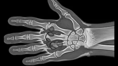 Tumor de células gigantes da bainha tendinosa