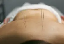 Pontos de acupuntura para coluna travada