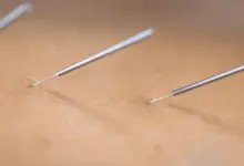 Pontos de acupuntura para dor no joelho