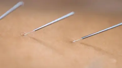 Pontos de acupuntura para dor no joelho